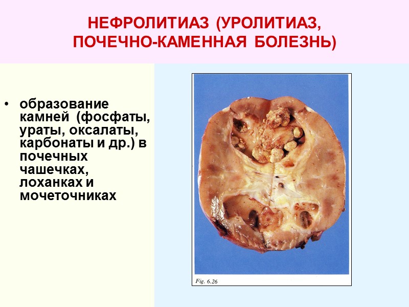 НЕФРОЛИТИАЗ (УРОЛИТИАЗ,  ПОЧЕЧНО-КАМЕННАЯ БОЛЕЗНЬ)     образование камней  (фосфаты, ураты,